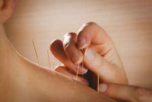 Acupuncture needles being inserted into patient ELEMENTAL SOLES's shoulder by a practitioner